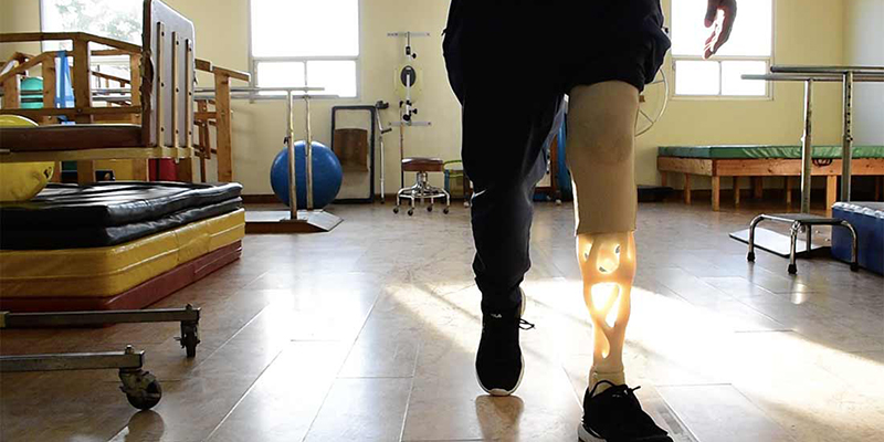 3D-Printed Prosthetics: Affordable Solutions for Amputees